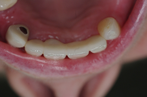 Salisbury dental fillings